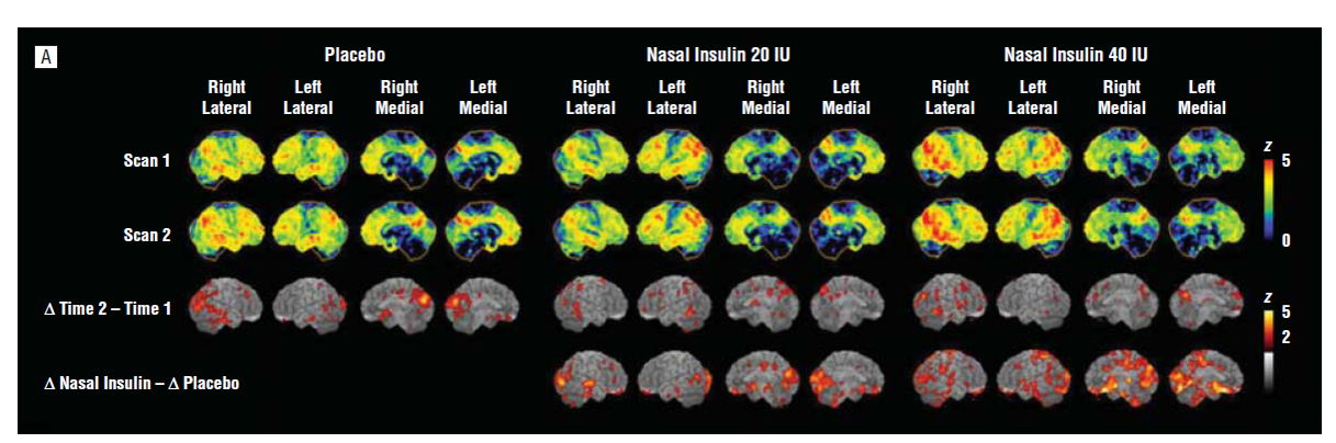 Alzheimer’s Disease from a Neurological Perspective